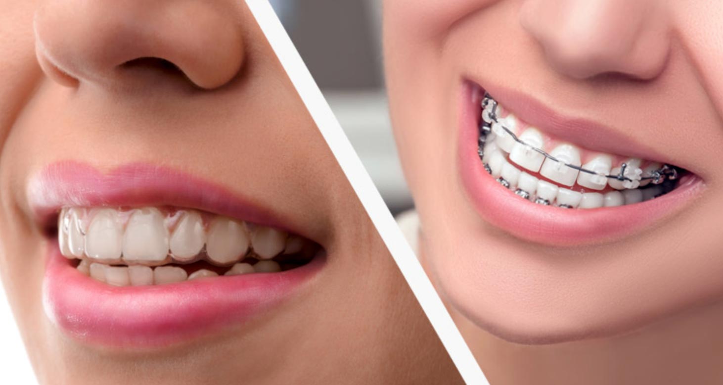 Choosing the Right Type of Braces