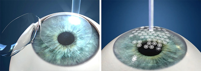 Benefits of ICL Surgery for Vision Correction